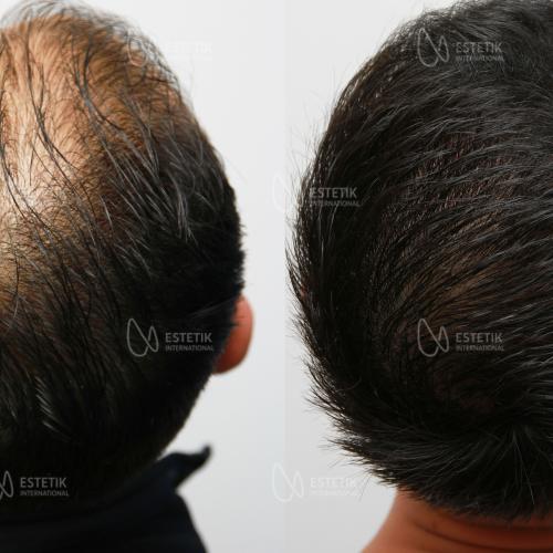 fotos antes y después de nuestros pacientes 8
